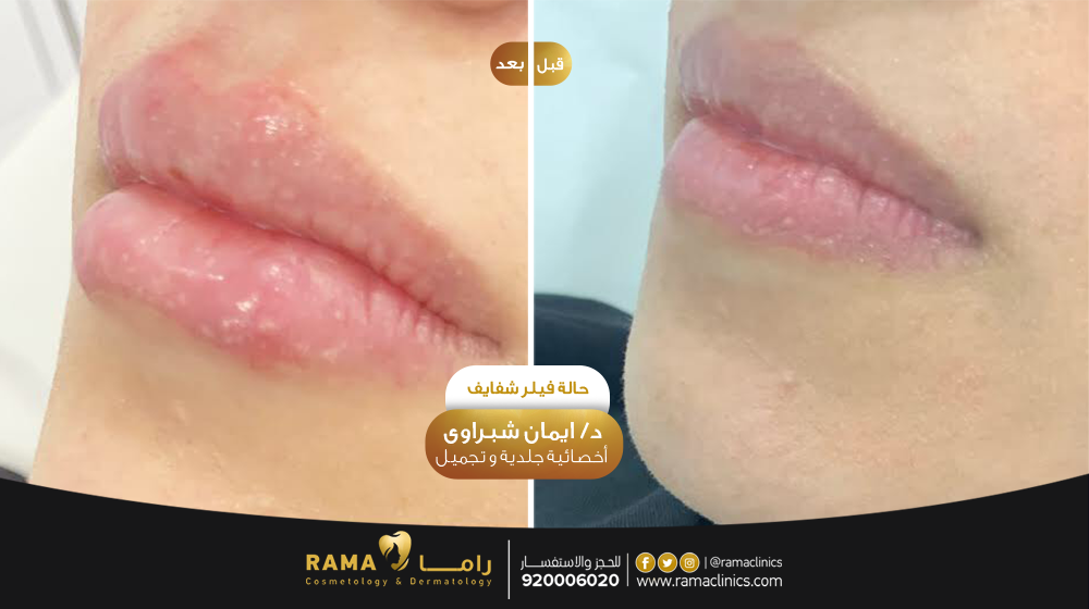 قبل العلاج