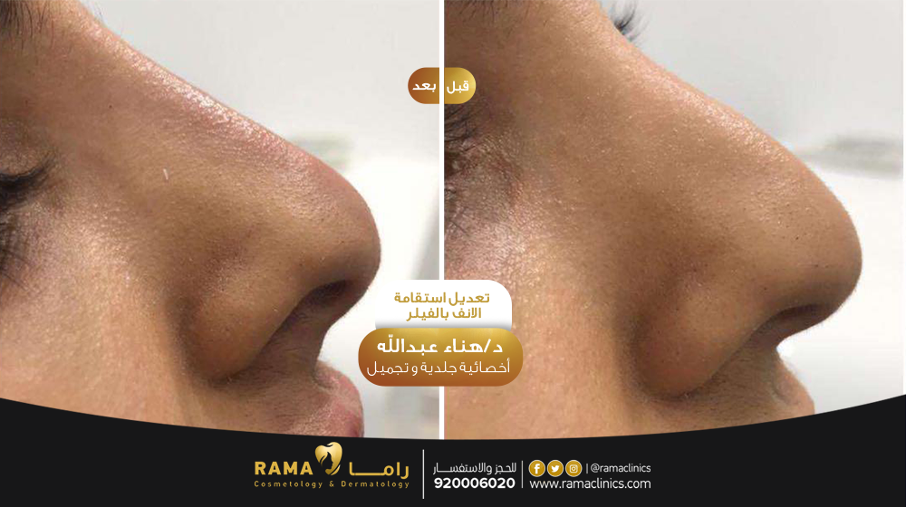 قبل العلاج
