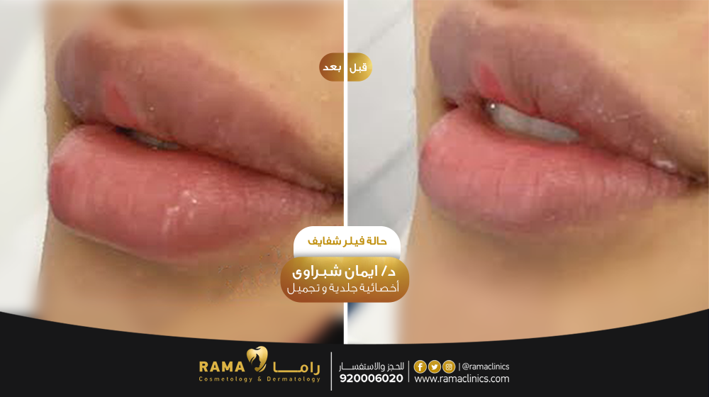 قبل العلاج