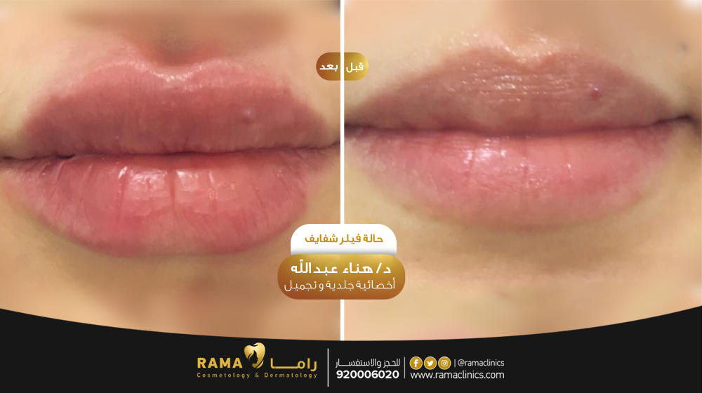 قبل العلاج
