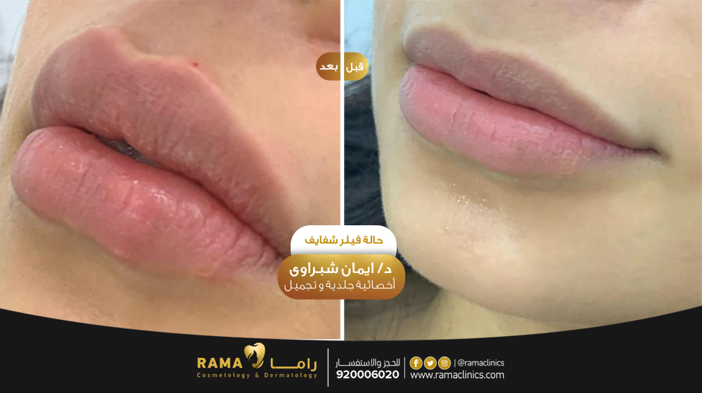 قبل العلاج
