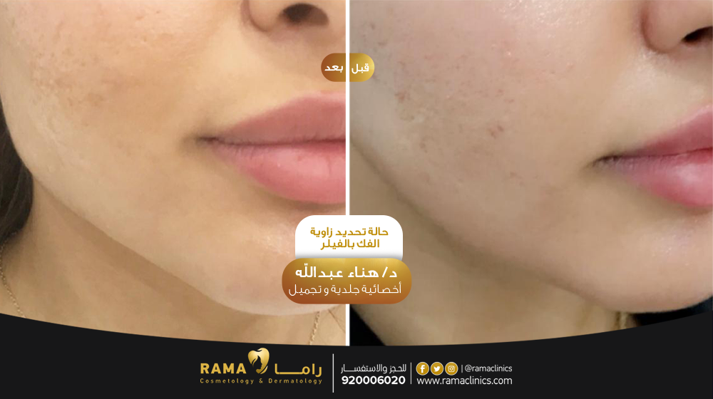 قبل العلاج