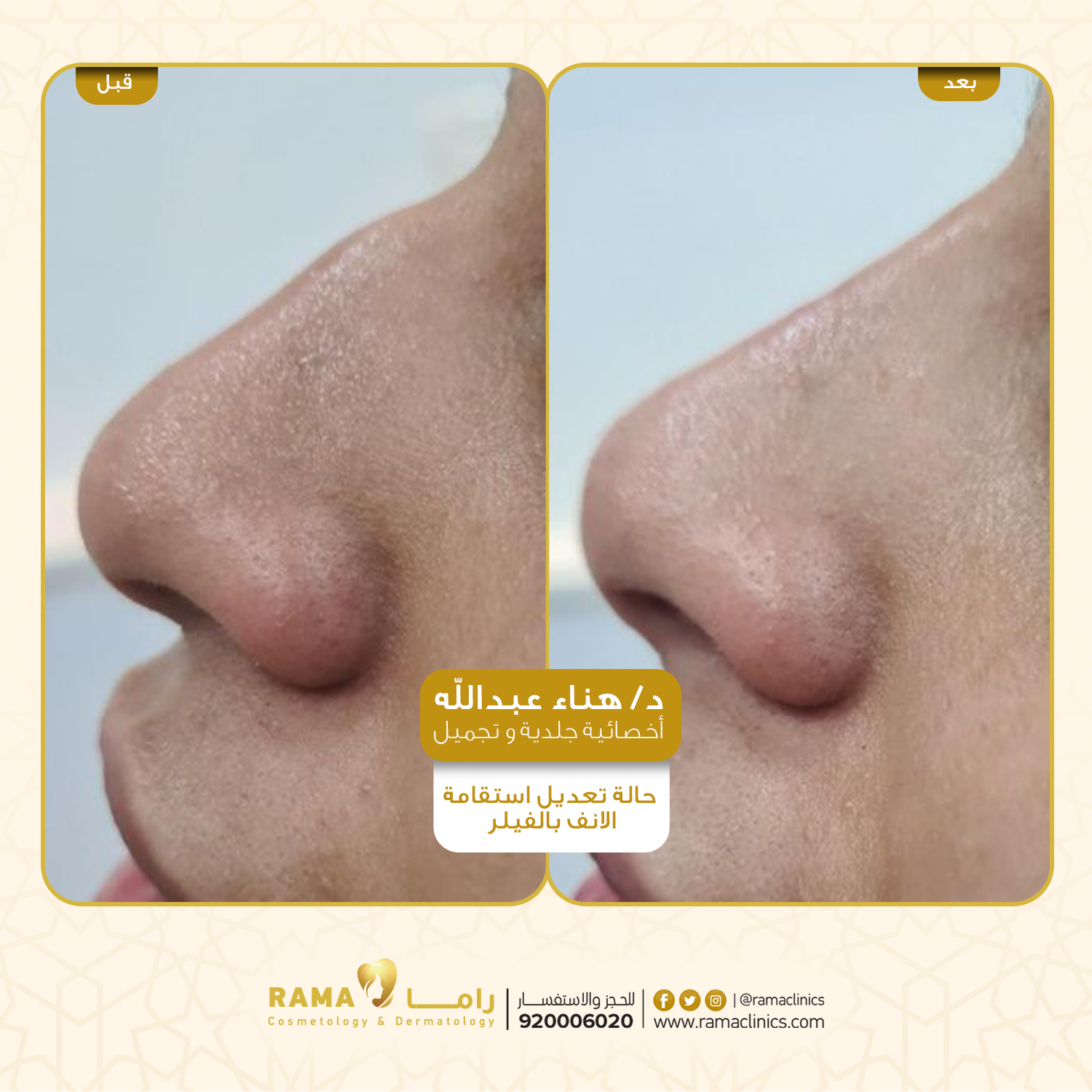 قبل العلاج
