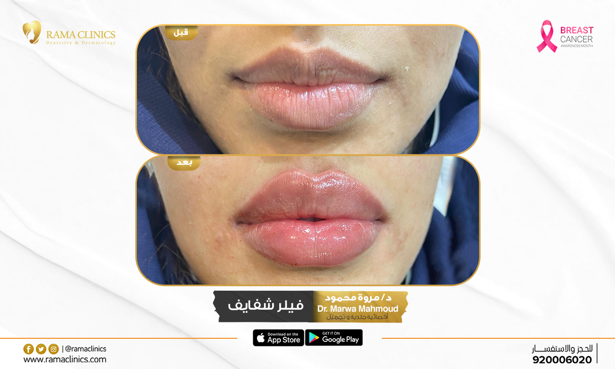 قبل العلاج