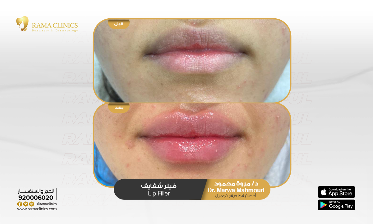 قبل العلاج