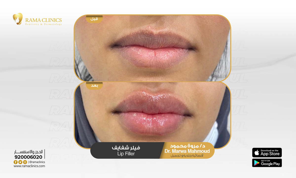 قبل العلاج