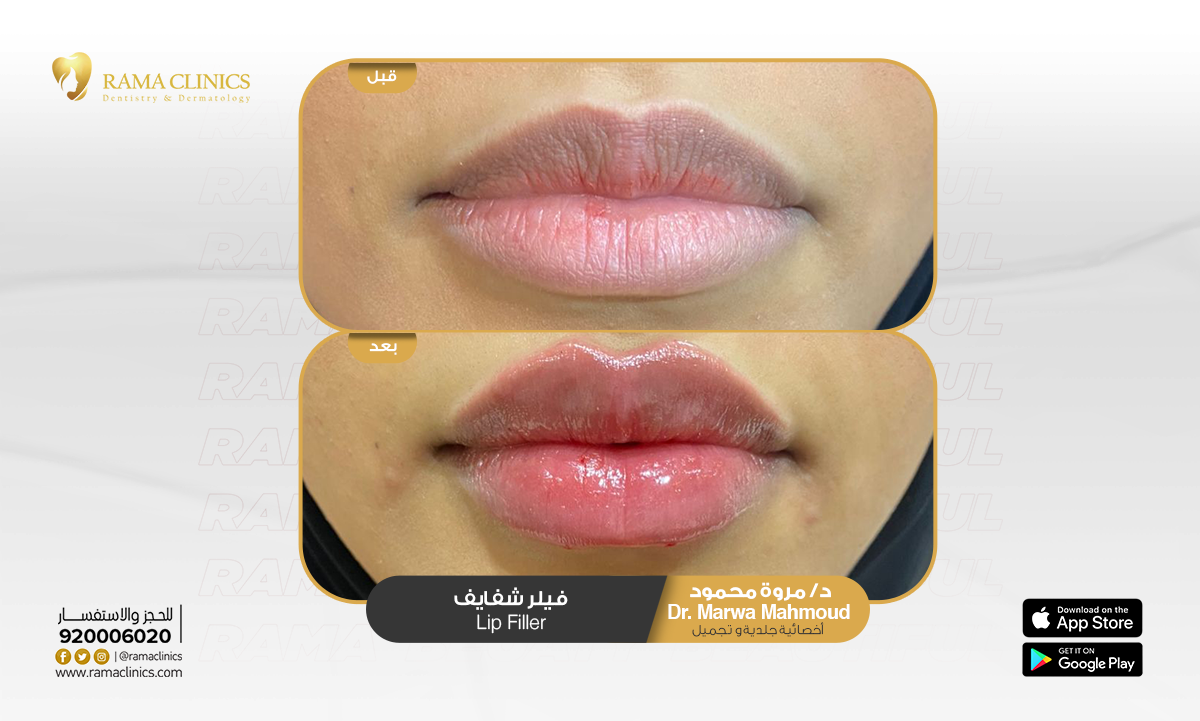 قبل العلاج