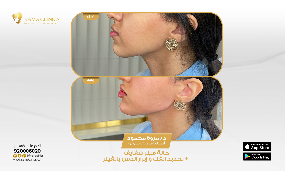 قبل العلاج