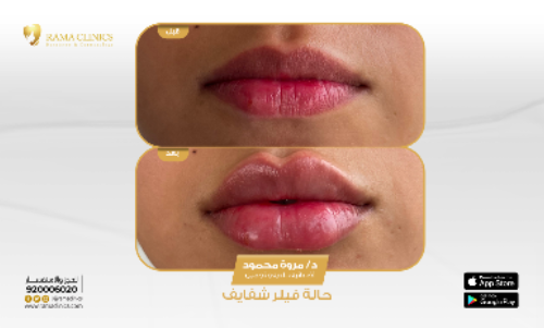 قبل العلاج